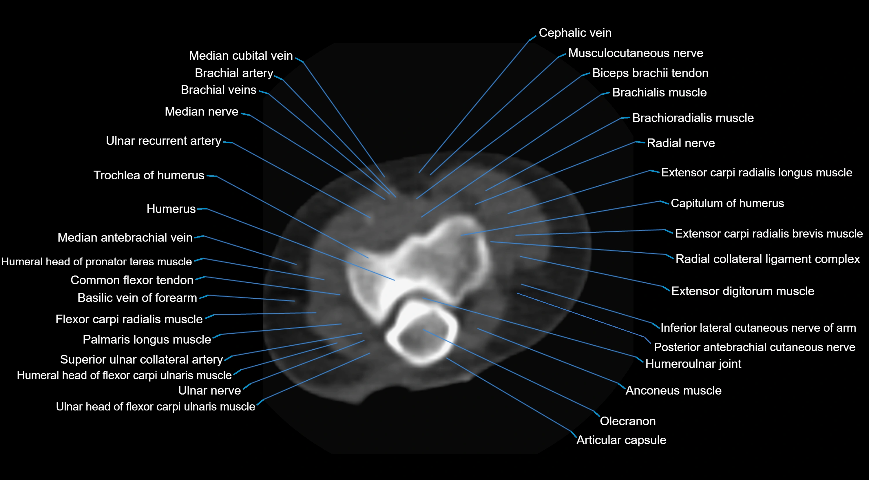 CT elbow axial  cross sectional anatomy labelled  radiology image -00025.webp